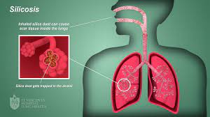 Silica Exposure Exams